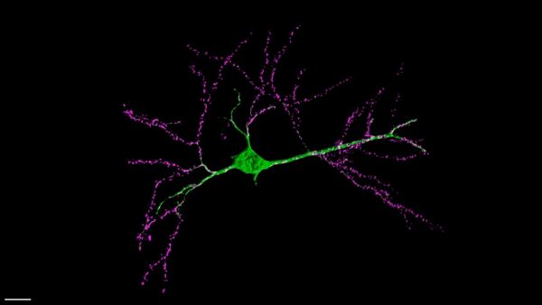 Photo : Neurone dans une tranche d’hippocampe du modèle de souris mis au point par l’équipe, dans laquelle le récepteur du glutamate GluA2 est « étiqueté » de telle manière à ce qu’on puisse marquer un neurone isolé. Magenta : marquage de GluA2, sur les dendrites du neurone ; vert : GFP soluble qui marque le corps cellulaire et l’axone. Le neurone est imagé avec un microscope à feuille de lumière, une technologie d’imagerie haute-résolution.
© Angela Getz, Mathieu Ducros, Daniel Choquet / IINS et BIC / CNRS-université de Bordeaux-Inserm.