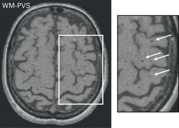 Photo : IRM cérébrale montrant une charge importante en espace périvasculaire dans la substance blanche © Nature Medicine